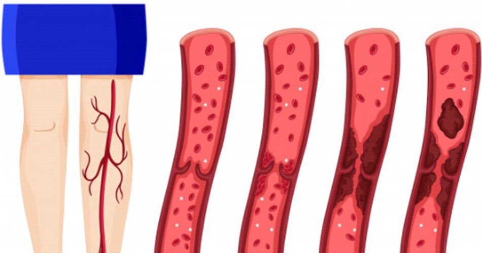 थ्रोम्बोसिस