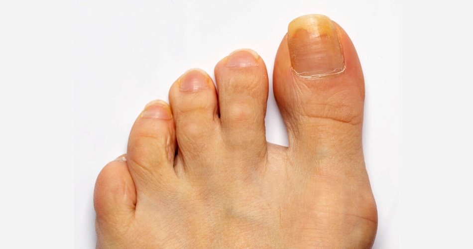 पीले नाखून