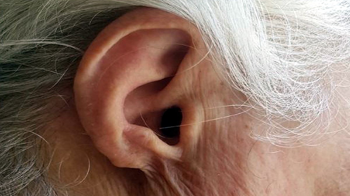 Woman Turkey Ear tuberculosis infection