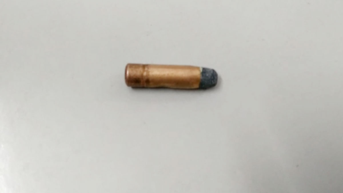 महिला की पीठ में फंसी थी गोली (फोटो-उमेश मिश्रा)