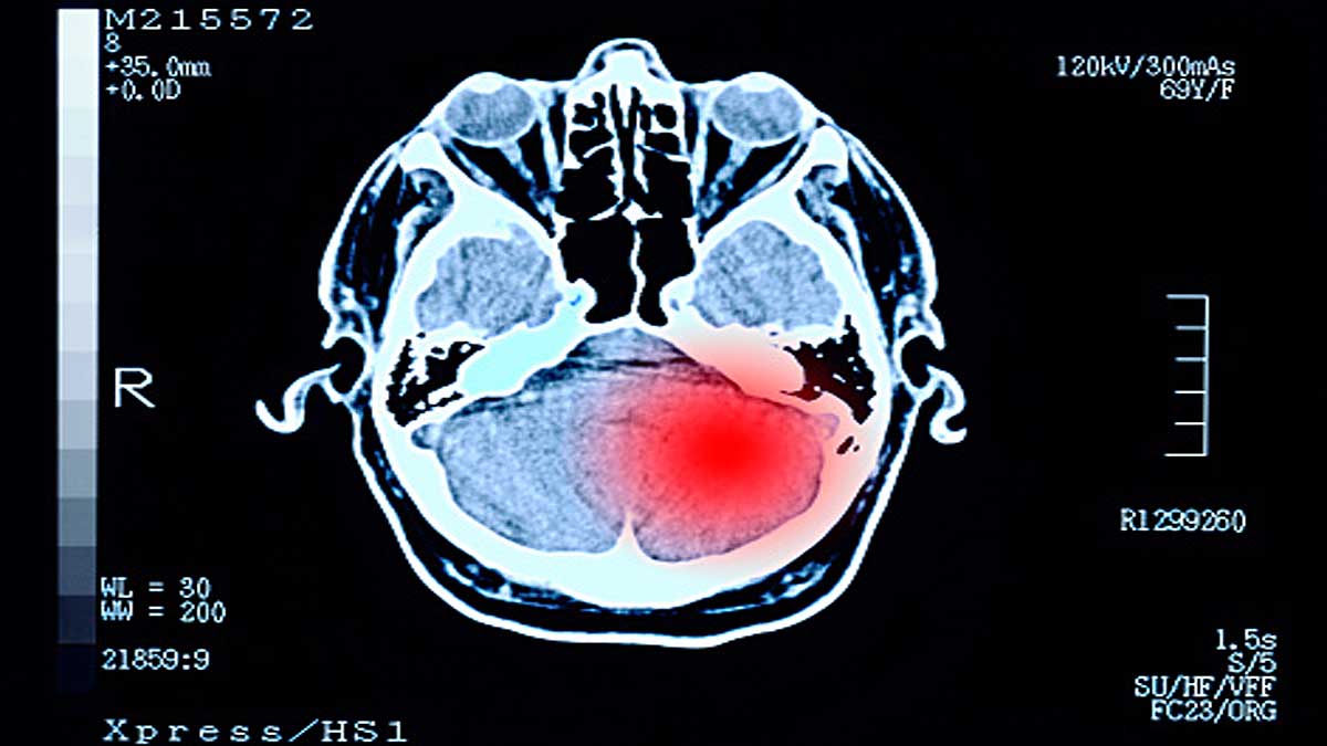 85% Covid-19 patients multiple brain diseases