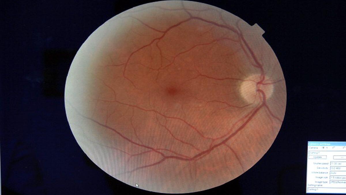 Artificial Intelligence detect Diabetes of Eyes