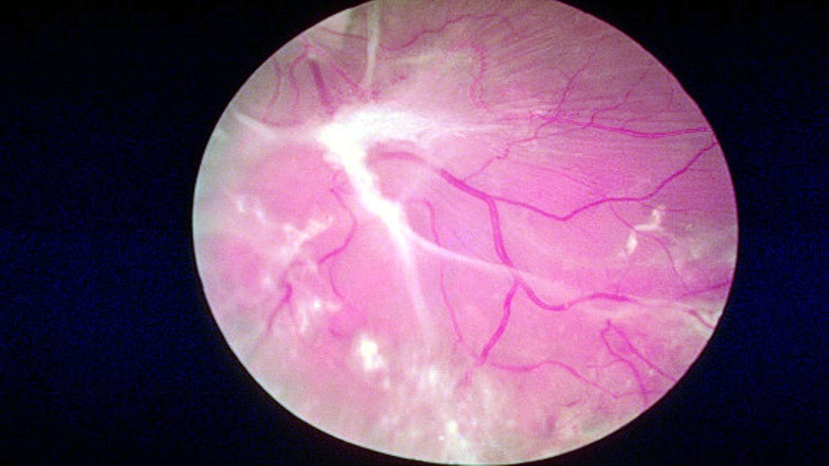 Artificial Intelligence detect Diabetes of Eyes