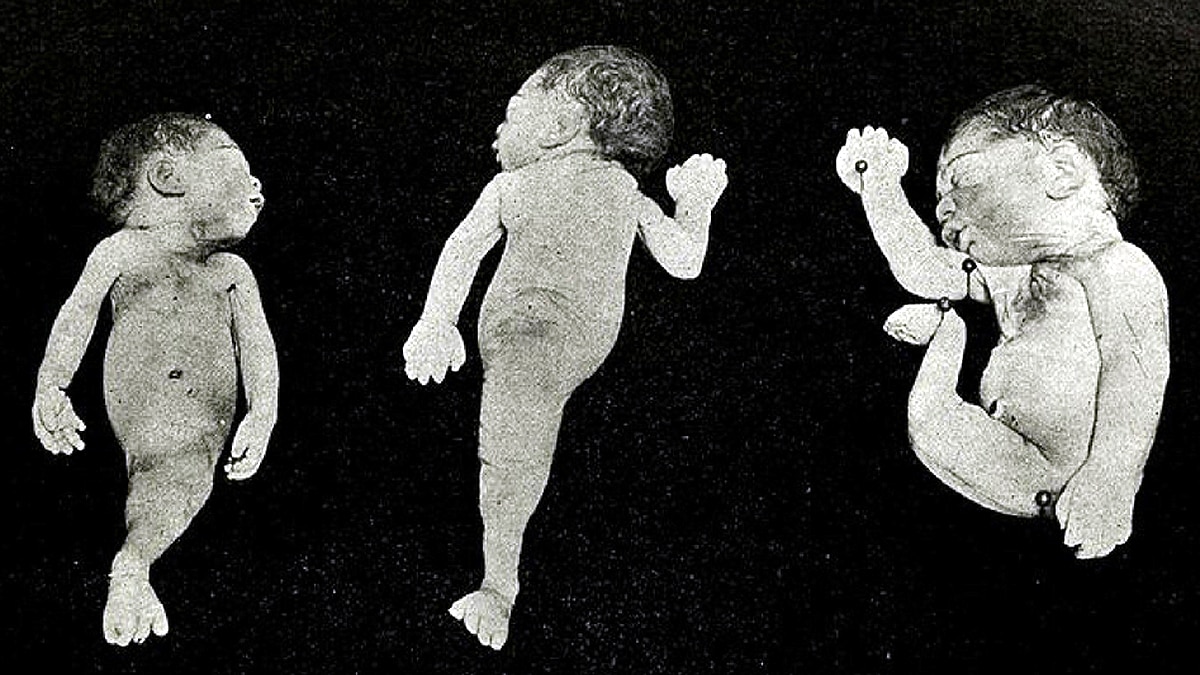 Mermaid Baby born in Hyderabad