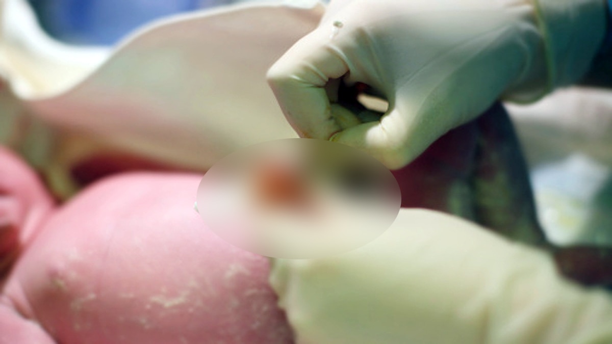 Mermaid Baby born in Hyderabad