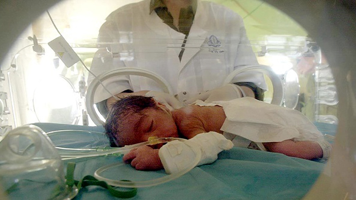 Mermaid Baby born in Hyderabad