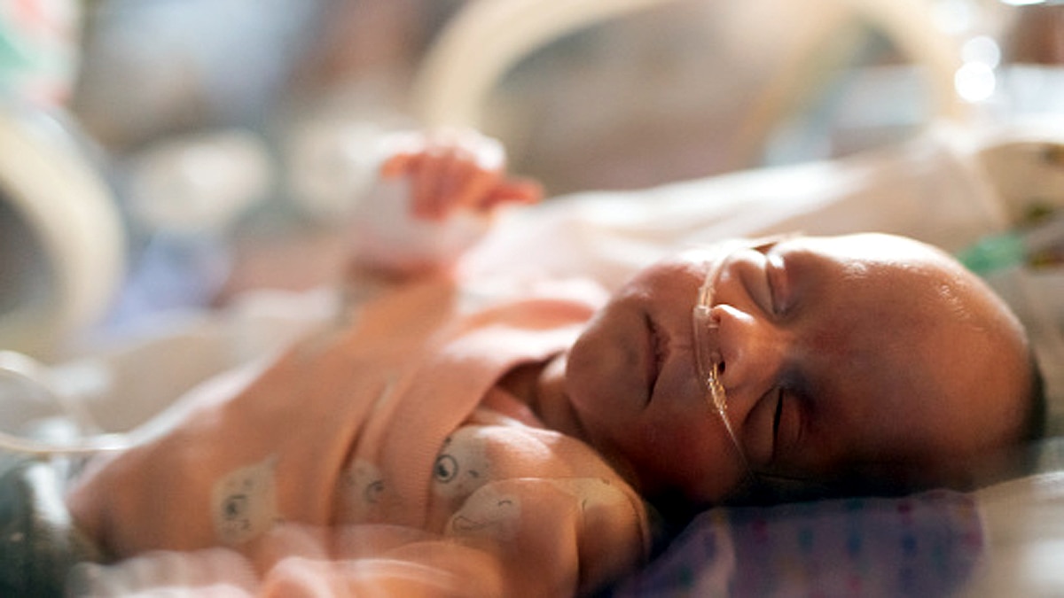 Mermaid Baby born in Hyderabad