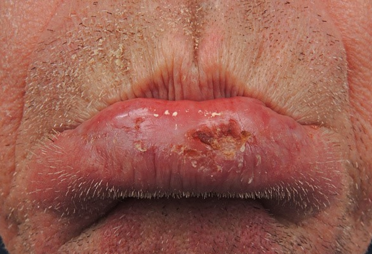 माउथ कैंसर के अन्य लक्षण