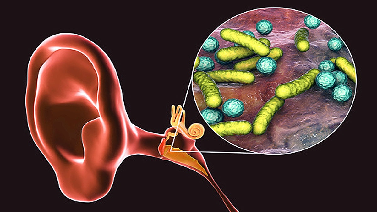 Woman Turkey Ear tuberculosis infection