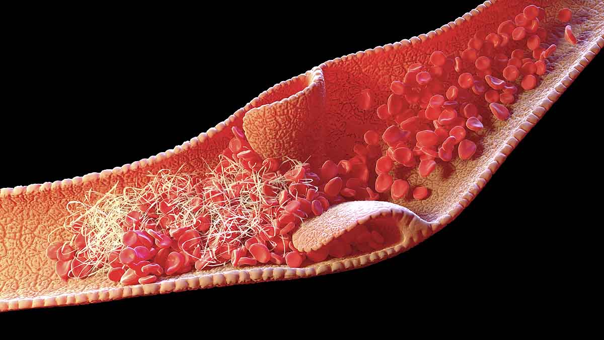 AstraZeneca Covid jab Blood Clot 