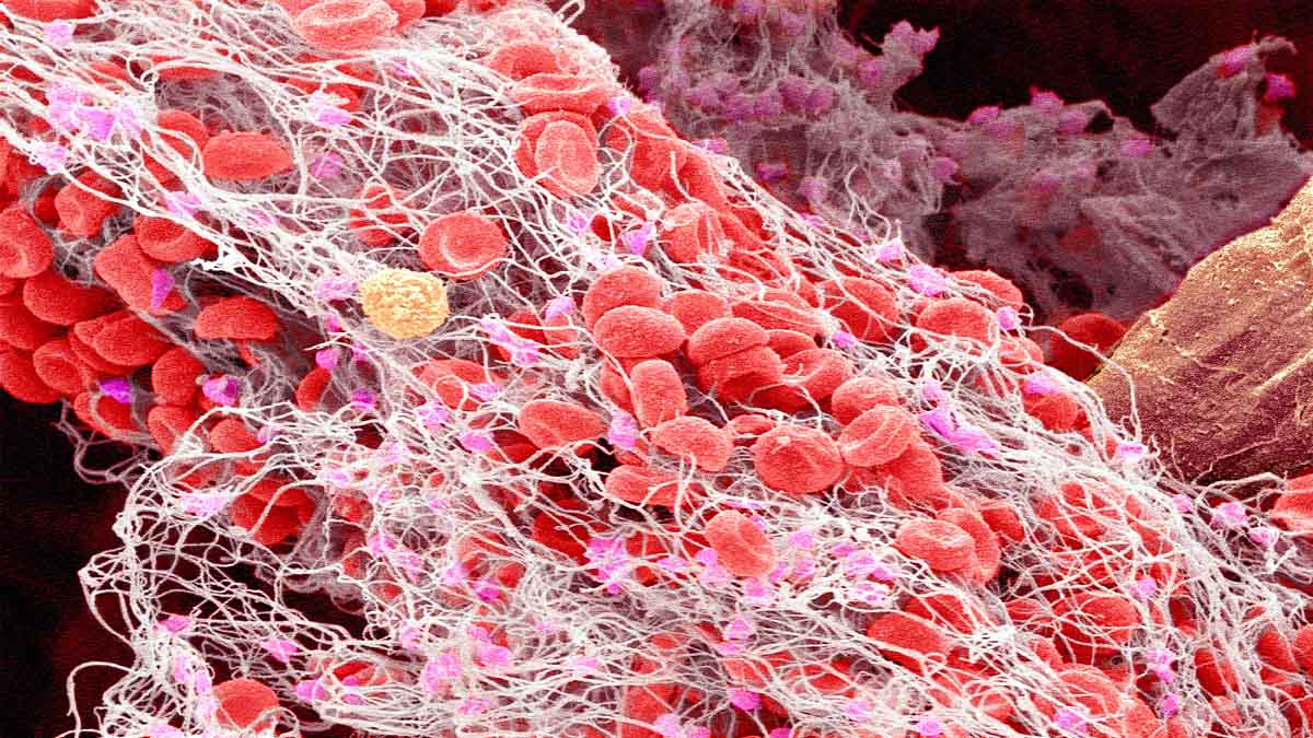 AstraZeneca Covid jab Blood Clot 