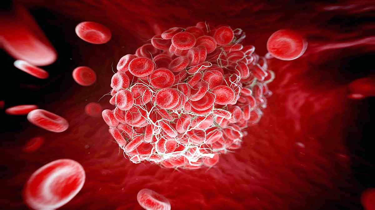 AstraZeneca Covid jab Blood Clot 