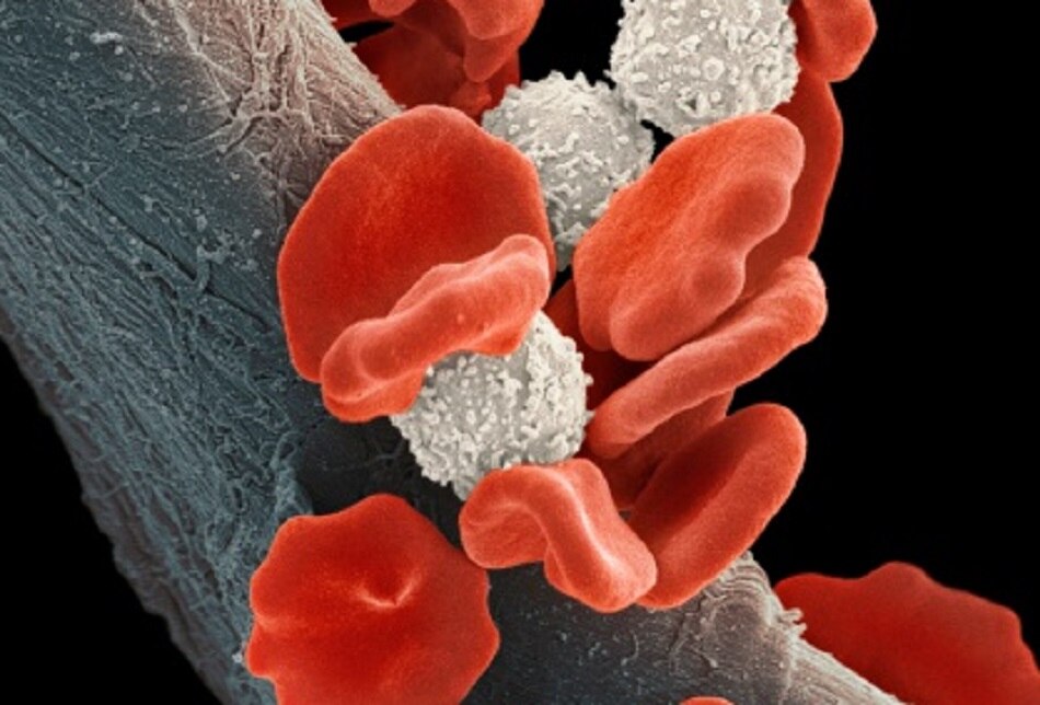 ल्यूकेमिया