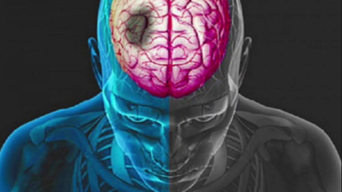 ब्रेन स्ट्रोक