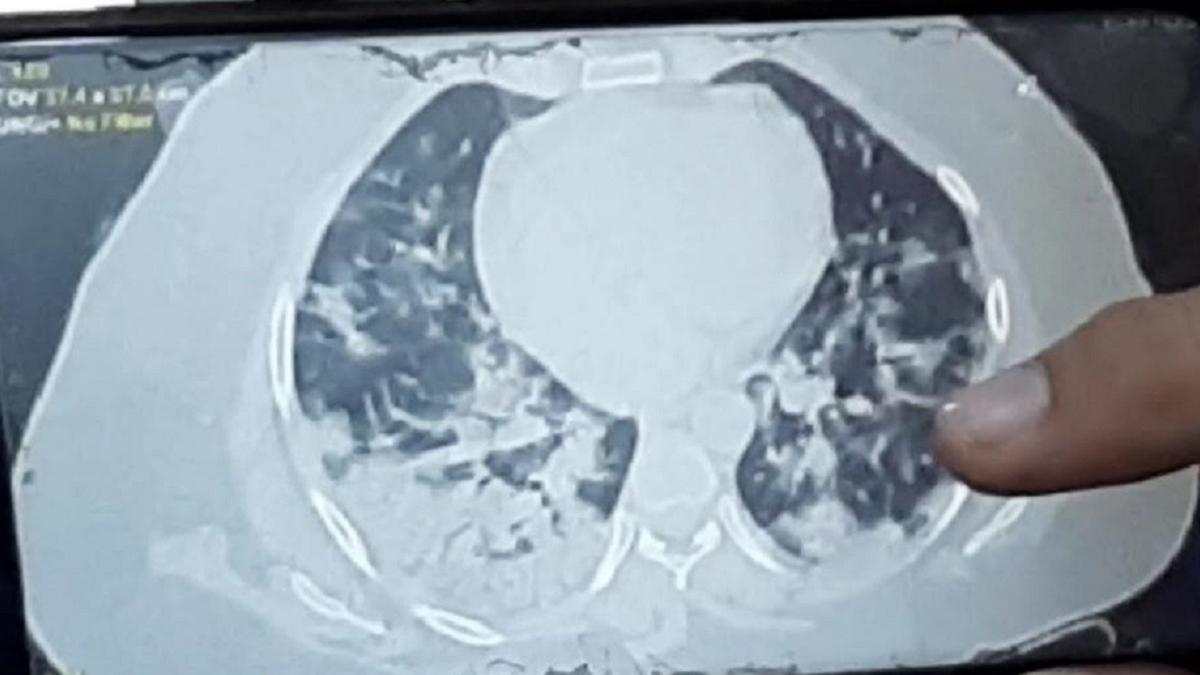 24 घंटे में 32 साल की महिला के फेफड़े खराब