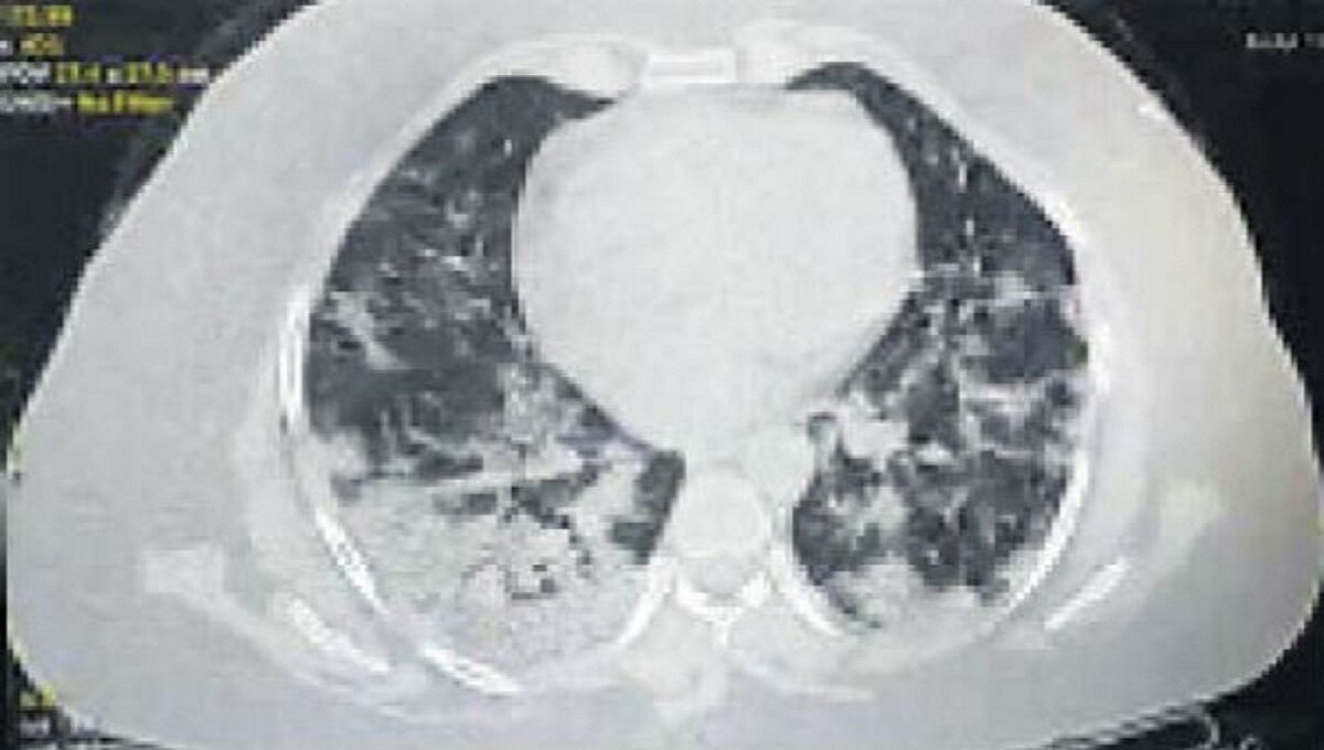 24 घंटे में 32 साल की महिला के फेफड़े खराब
