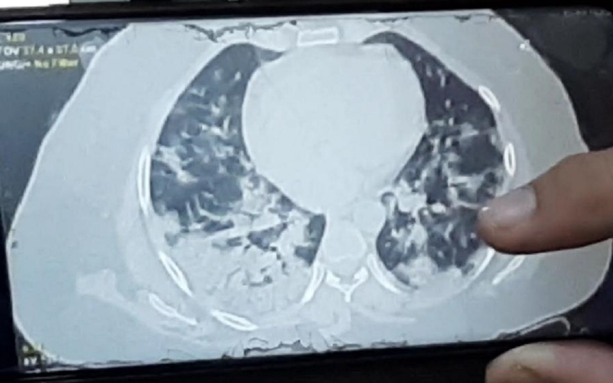 24 घंटे में 32 साल की महिला के फेफड़े खराब