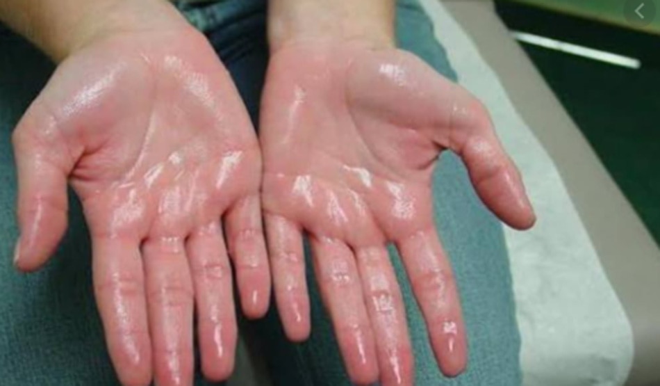 पसीना आना 