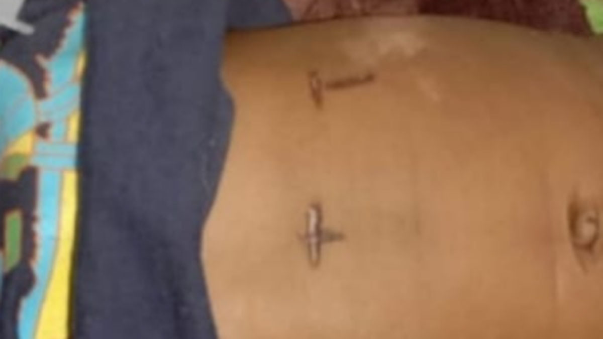 इलाज के लिए मासूम के पेट पर तीन बार गर्म सलाखों को दागा