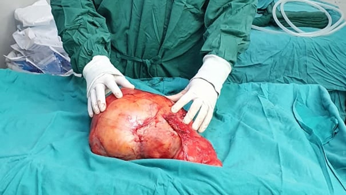डॉक्टरों ने लड़की पेट से दो फुटबॉल के बराबर ट्यूमर निकाला 