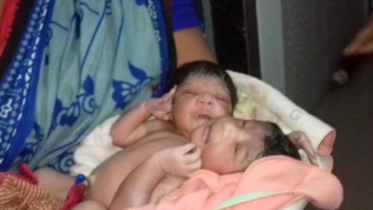 ओडिशा में दो सिर और तीन हाथ के साथ बच्ची का जन्म