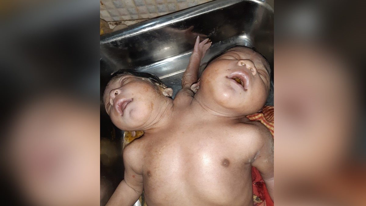 ओडिशा में दो सिर और तीन हाथ के साथ बच्ची का जन्म