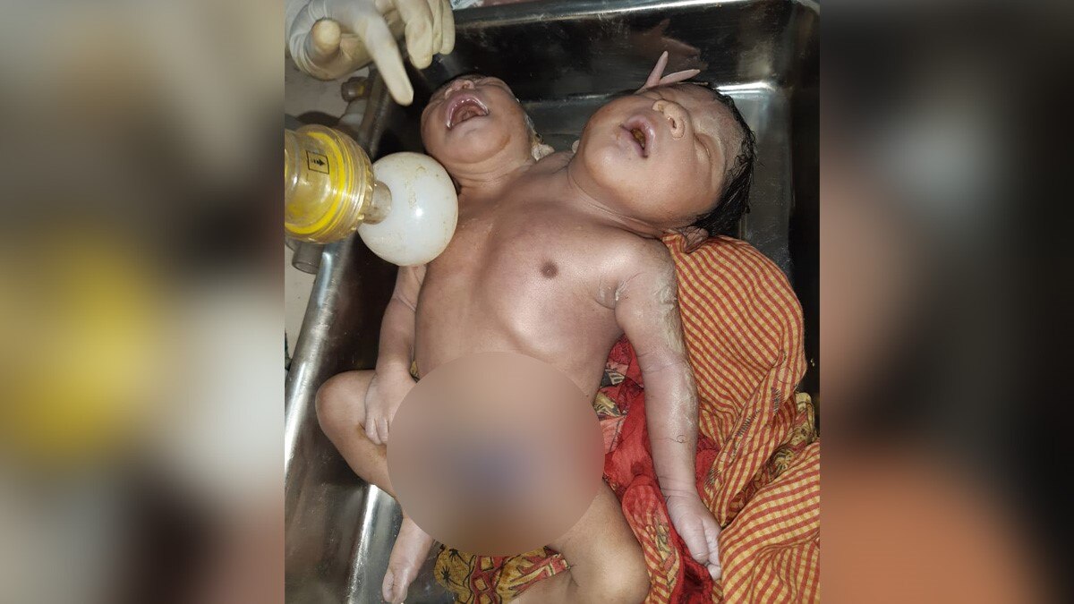 ओडिशा में दो सिर और तीन हाथ के साथ बच्ची का जन्म