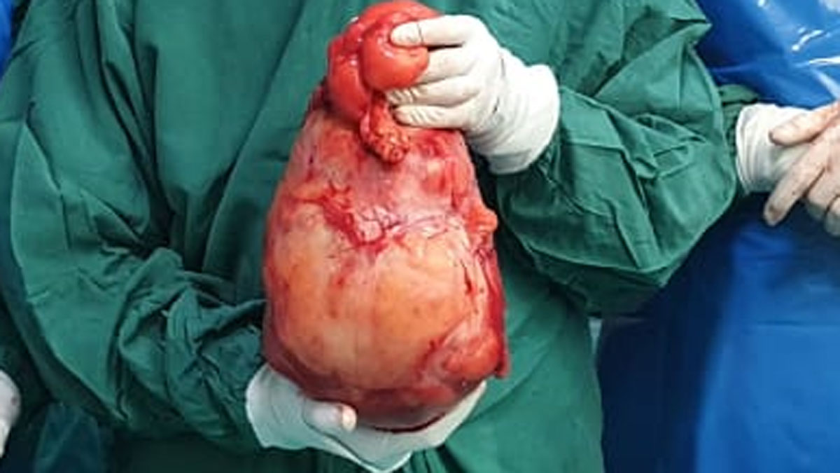 डॉक्टरों ने लड़की पेट से दो फुटबॉल के बराबर ट्यूमर निकाला 