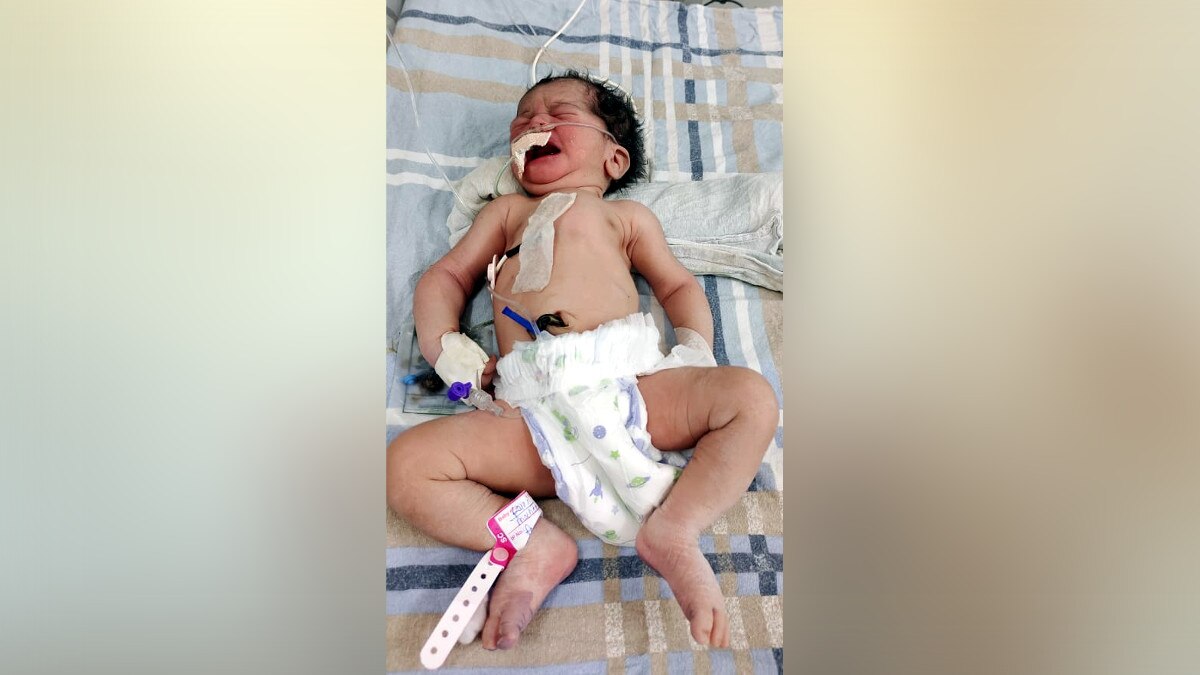 Delivery of corona infected woman