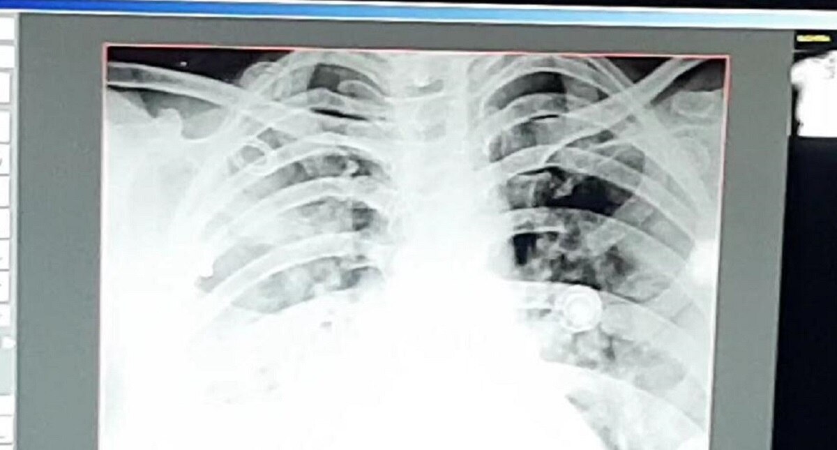 24 घंटे में 32 साल की महिला के फेफड़े खराब