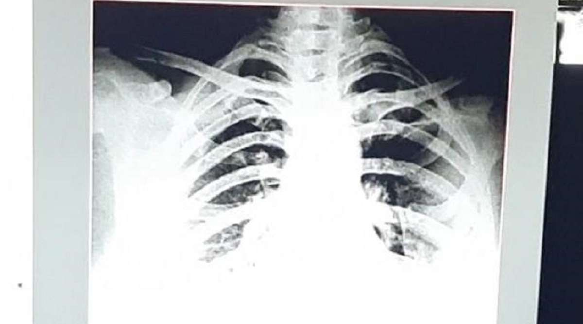 24 घंटे में 32 साल की महिला के फेफड़े खराब