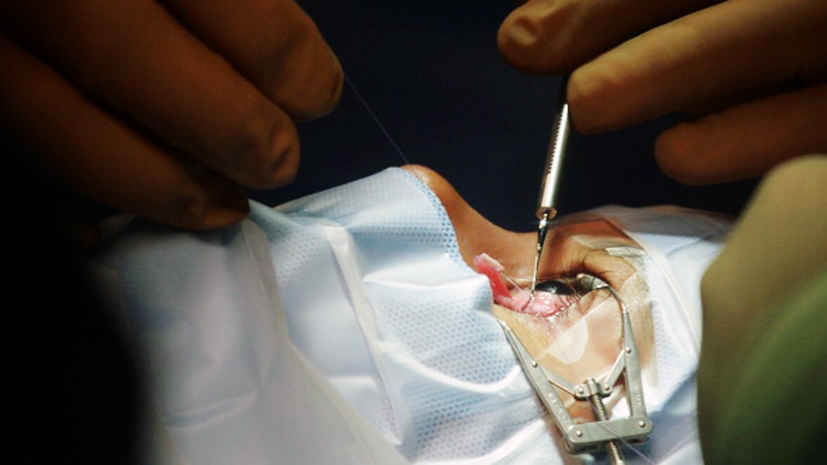 म्यूकोरमाइकोसिस के लक्षण