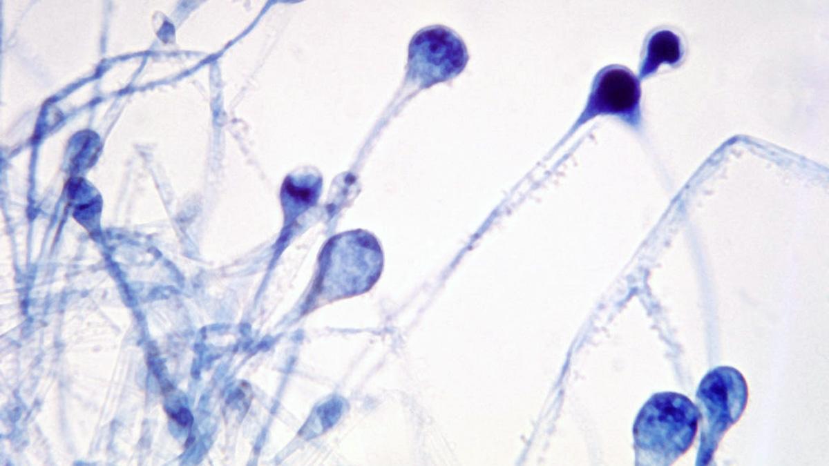 ब्लैक फंगस का खतरा