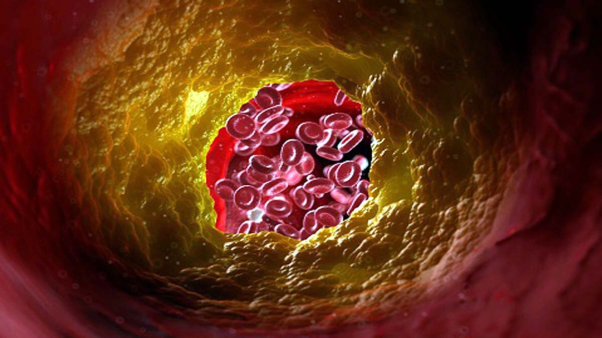 Rare Blood Clot Covid Vaccine