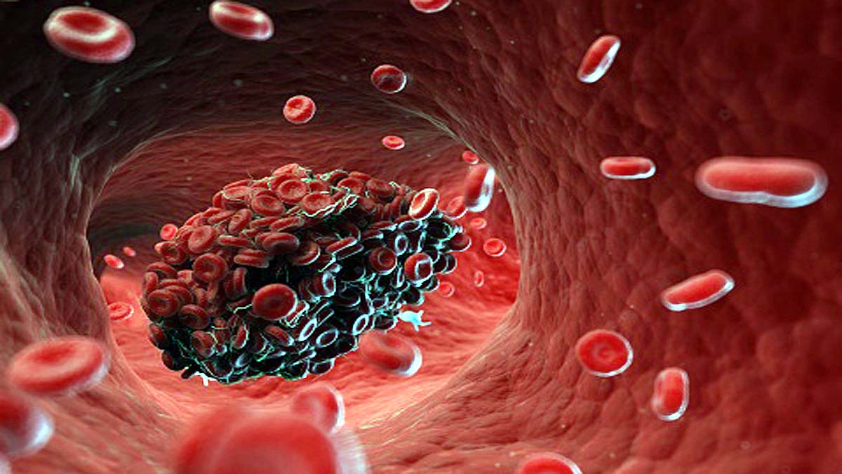 Rare Blood Clot Covid Vaccine