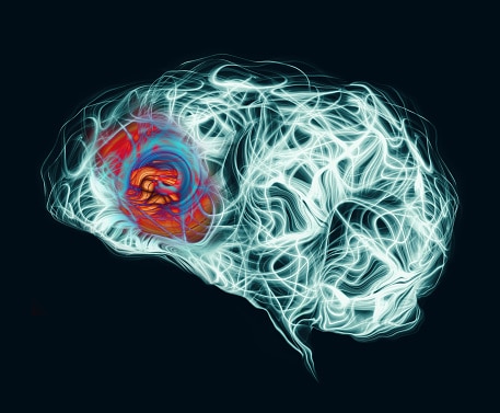 सिजोफ्रेनिया के शुरुआती लक्षण- 