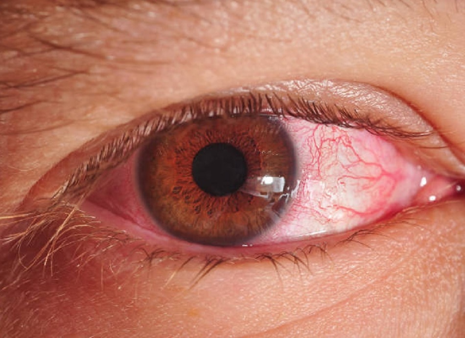 हल्की लाल आंखें