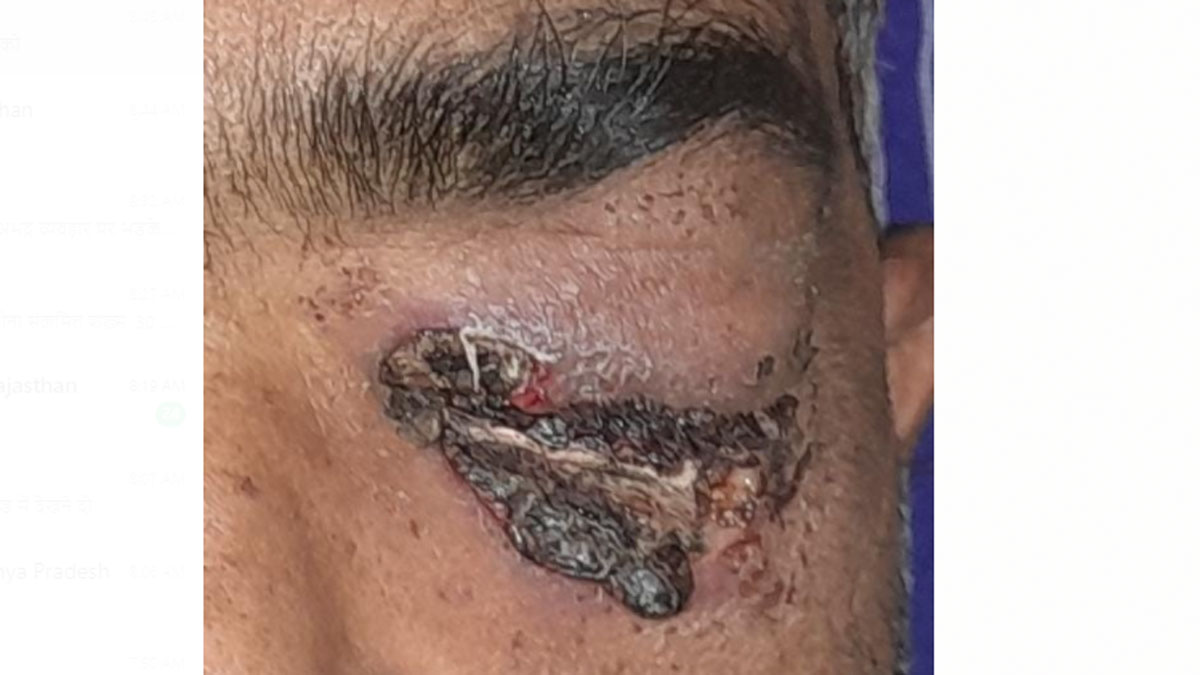 कोरोना के बाद नई बीमारी से दहशत का माहौल 