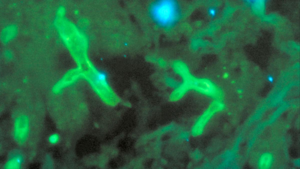  एस्परजिलोसिस के लक्षण