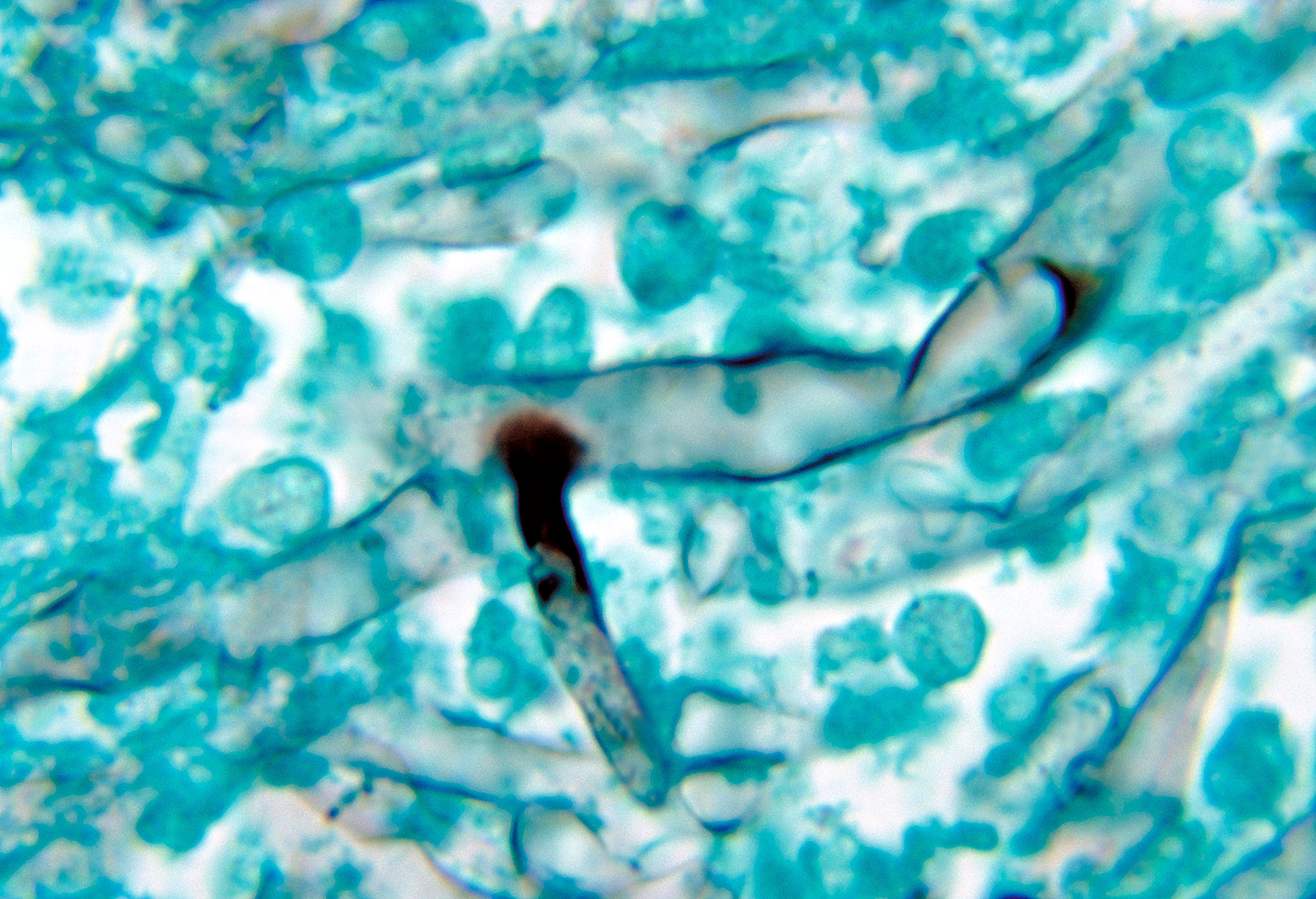 एस्परजिलोसिस 