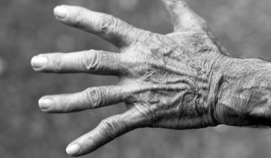 रूमेटाइड अर्थराइटिस9