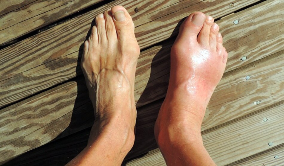 रूमेटाइड अर्थराइटिस4