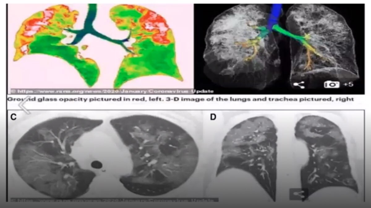 कोरोना हमारे फेफड़ों पर कैसे करता है असर