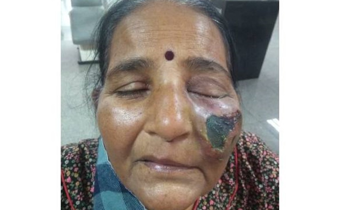 म्यूकरमाइकोसिस इंफेक्शन