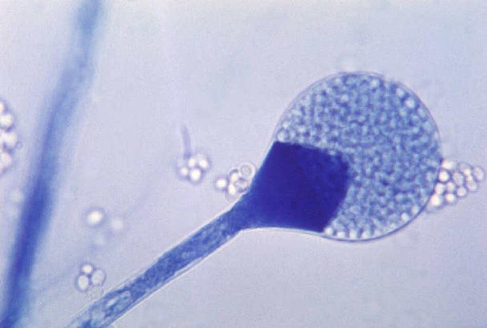 म्यूकरमाइकोसिस से कैसे बचें