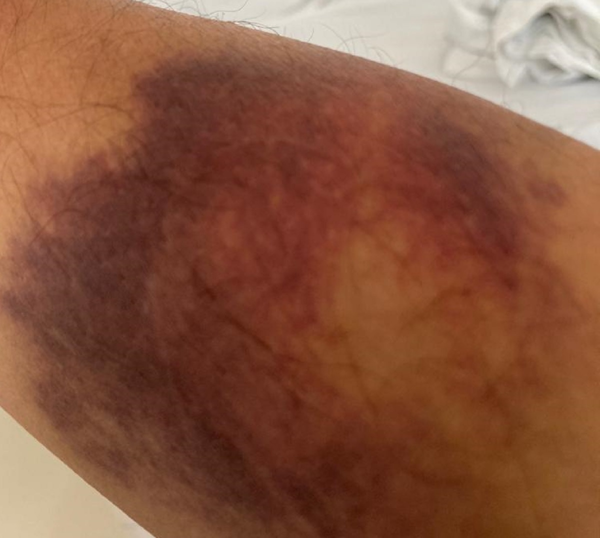 अस्पताल में मेहुल चोकसी