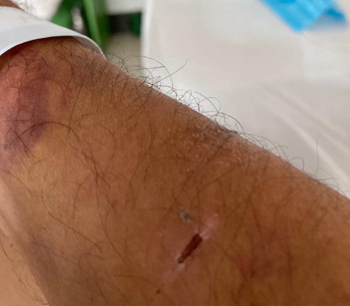 अस्पताल में मेहुल चोकसी