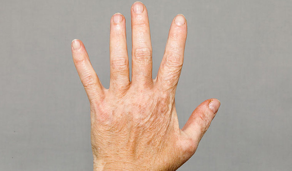 विटिलिगो