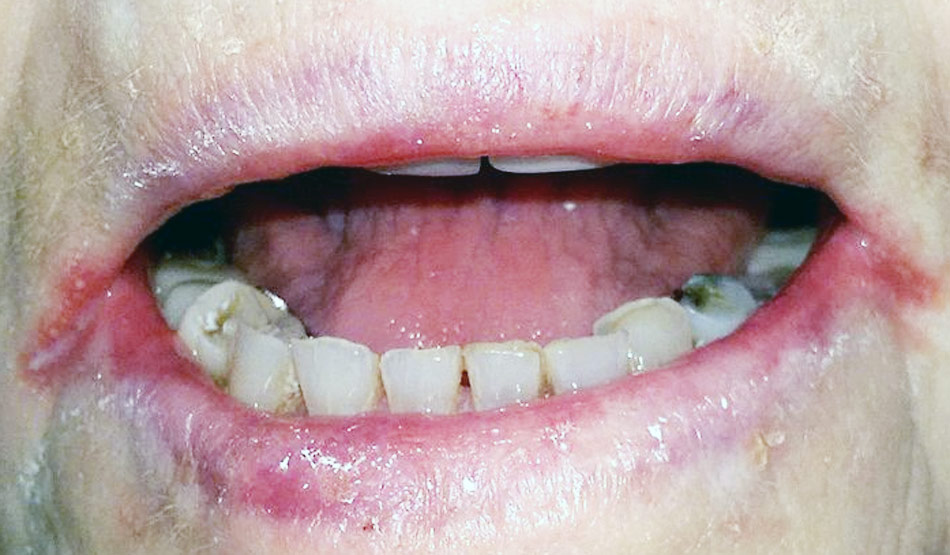 एंगुलर चेलाइटिस