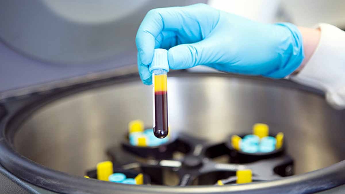Covid-19 Vaccine Low Platelet 